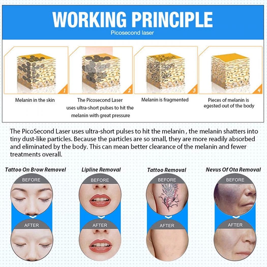 2022 Portable Professional Laser Tattoo Removal Picosecond Machine 